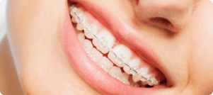 Ceramic Braces