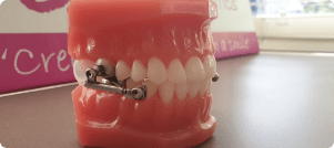 Ceramic Braces