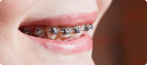 Ceramic Braces