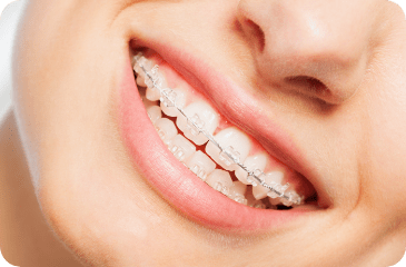 Ceramic Braces